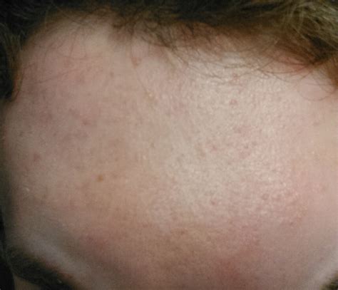 Small Colorless Bumps All Over Forehead General Acne Discussion Forum