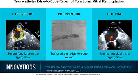 Transcatheter Edge To Edge Repair Of Functional Mitral Regurgitation