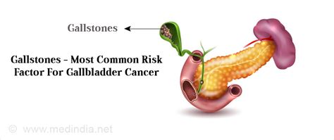 Gallbladder Cancer Medical Tech News The Latest Health News