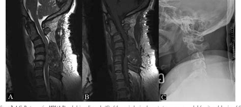 Pdf Acute Swan Neck Deformity And Spinal Cord Compression After