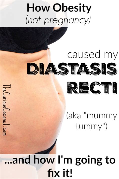 How Obesity Caused My Diastasis Recti — The Curious Coconut