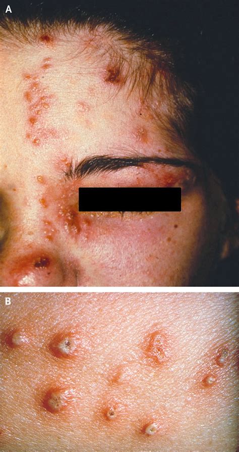 Herpes Zoster Nejm