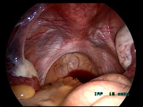 The fallopian tubes connect the ovaries to the uterus. Female Laparoscopy & Infertility by Fertility Doctor ...