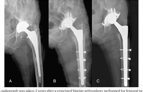 Bipolar Hemiarthroplasty Vs Total Hip Replacement