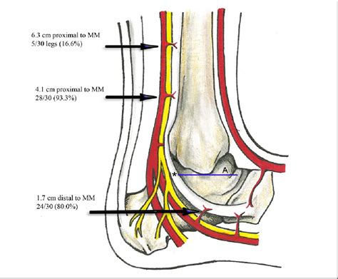 Figure From Arterial Anatomy Of The Tibialis Posterior Tendon