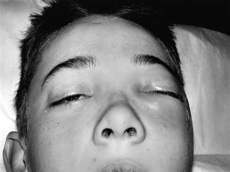 Periorbital Swelling The Important Distinction Between Allergy And