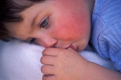 What Is Scarlet Fever What Are The Symptoms Is The Rash Contagious