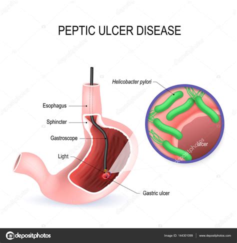 Peptic Ulcer Diagram