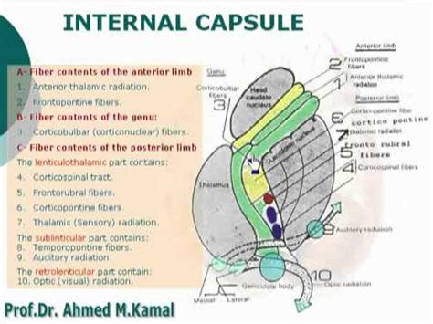 Infarction: Internal Capsule Infarct