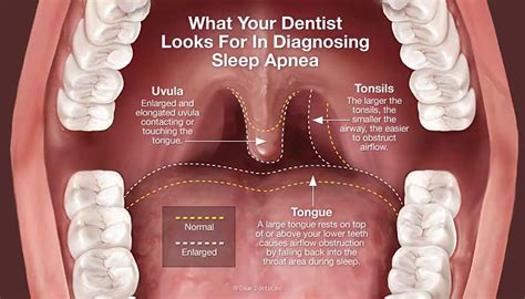 sleep apnea treatments martindale dental