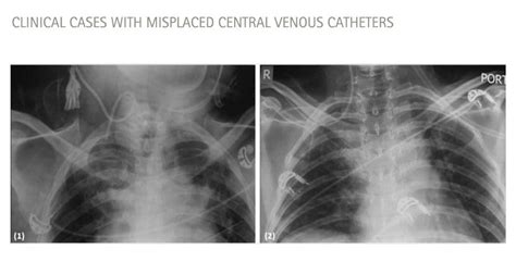 Central Venous Catheter X Ray