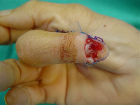 Trauma: Thenar Flaps for Fingertip Reconstruction