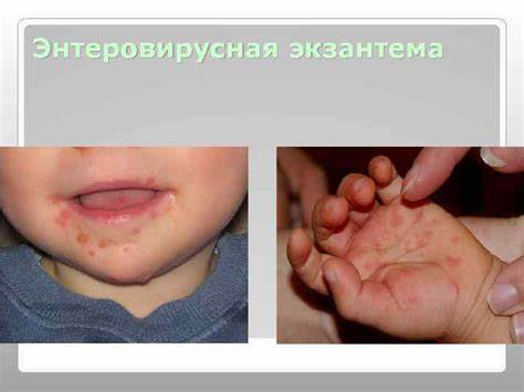 Энтеровирусные инфекции т д м н проф Картинка - Энтеровирусные инфекции т д м н проф