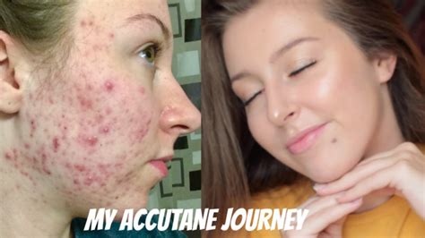 My Isotretinoin Accutane Journey Before And After Photos Youtube