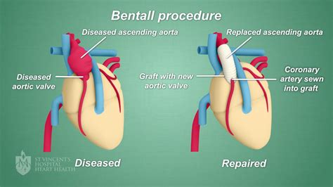 Physical Limitations After Aortic Valve Replacement Phyqas