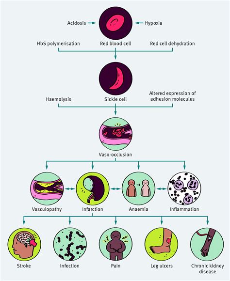 Management Of Sickle Cell Disease In The Community The Bmj