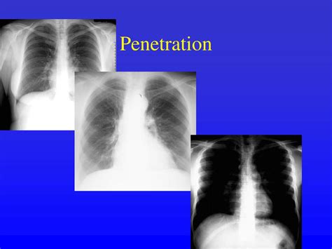 Ppt Reading The Cxr Powerpoint Presentation Free Download Id3651736