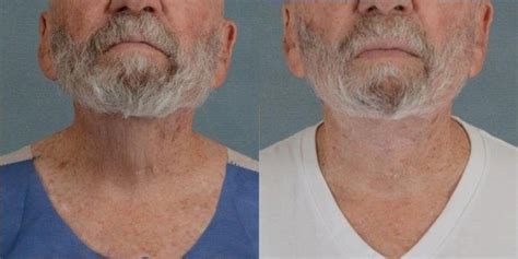 Neck Lift Before And After Photo Gallery Tallahassee Fl