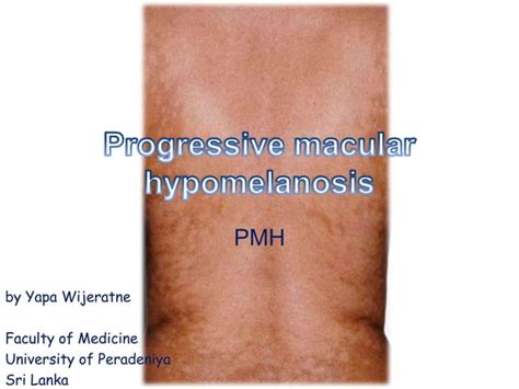 Progressive Macular Hypomelanosis Pmh