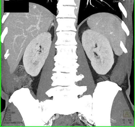 Small Pheochromocytoma Right Adrenal Gland Adrenal Case Studies