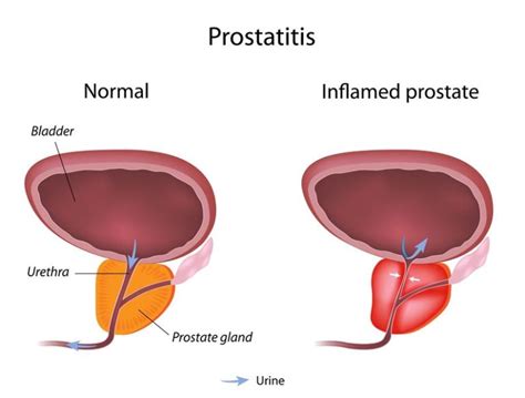 Enlarged Prostate Which Is The Best Treatment Option Medfin
