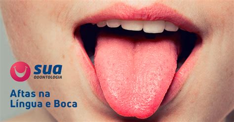Aftas Na Língua E Na Boca Sua Odontologia São Paulo E Jundiaí