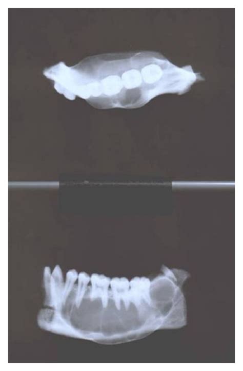 Radiograph Of Resected Segment Of Right Side Mandible Download
