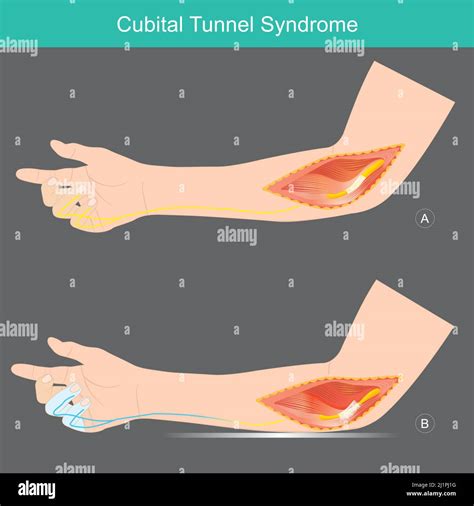 Síndrome Del Túnel Cubital Afección Que Implica Presión O Estiramiento