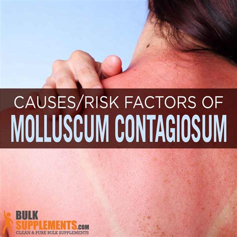 Molluscum Contagiosum Symptoms Causes Treatment Vrogue