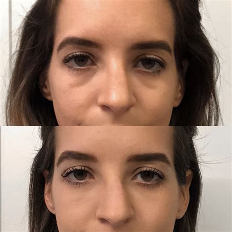 Under Eye Fillers Dark Circle Reduction Before And After Photos Dallas