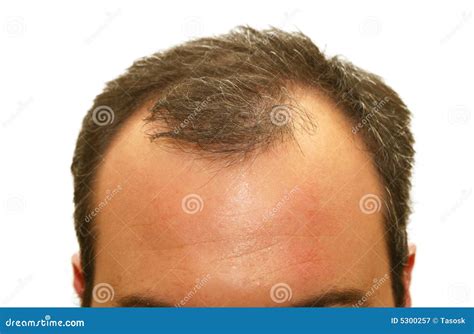 Balding Head Stock Image Image Of Improvement Forehead 5300257