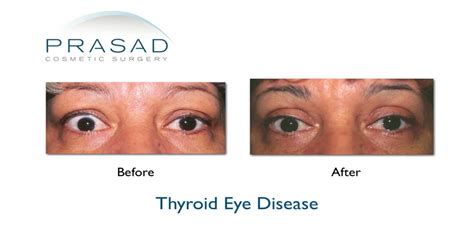 Thyroid Eye Disease Surgery Graves Eye Disease Surgery Dr Prasad