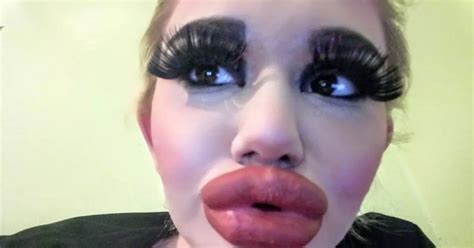 Barbie Wannabe Injects Acid Into Lips Times In Bid To Make Them