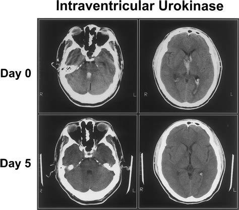 Treatment Of Intraventricular Hemorrhage With Urokinase Stroke