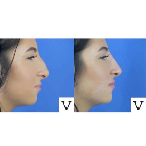 How Nose Fillers Pushed Away The Risky Surgical Procedures