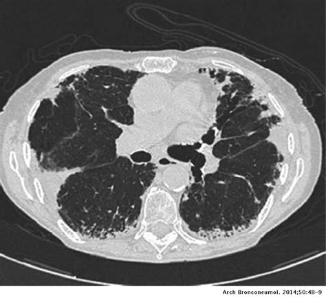A Case Of Interstitial Lung Disease With Apical Pleural Thickening