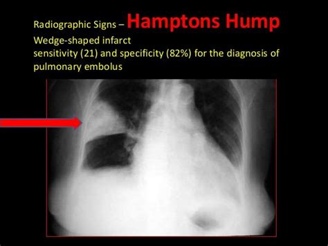 Note Wedge Shaped Opacity Or Hampton Hump Is Classical Feature Of