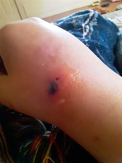 Brown Recluse Spider Bite Victim Lost Feeling In Wrist From Flesh