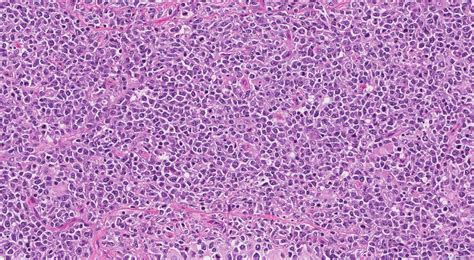 Diffuse Large B Cell Lymphoma Atlas Of Pathology