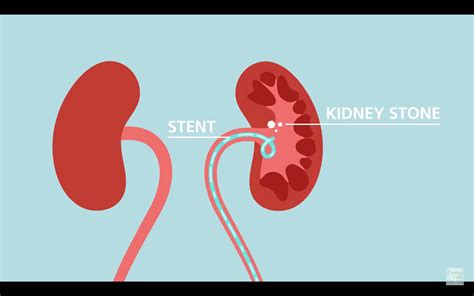 Kidney Stones And Ureteral Stents Credible Patient Resources