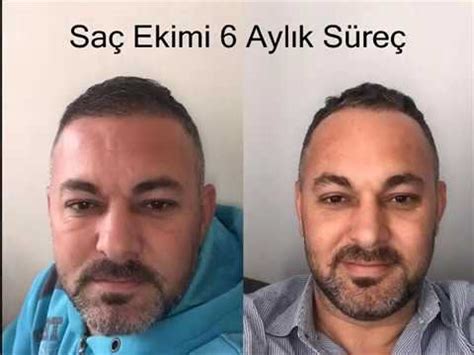 Saçlarınıza perma yaptırdıktan sonra çok iyi bir saç kremi kullanmanız gerekmektedir. Saç Ekimi Öncesi Sonrası (6 Aylık Süreç) - YouTube