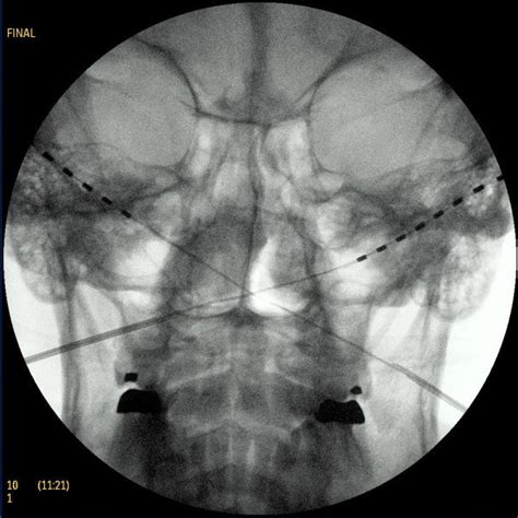 Infected Area Over The Site Of The Initial Occipital Implantation At