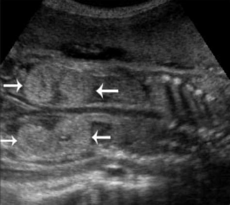Coronal Usg Of The Fetal Kidneys Shows Bilateral Echoge Open I