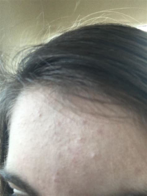 Bumps And Acne Only On The Forehead General Acne Discussion Acne