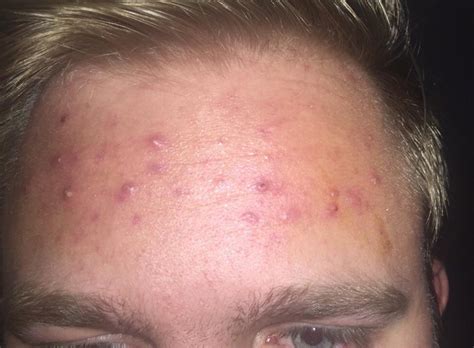 Skin Concerns Had A Very Large Breakout Of Cystic Acne On My Forehead