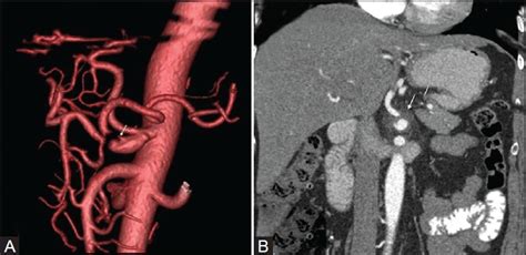 Dissecting Celiac Artery Aneurysm A Ct 3d Vr Image Shows Celiac