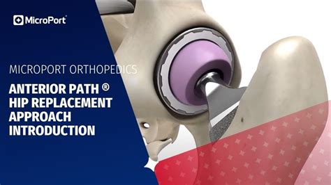 Anterior Path ® Hip Replacement Approach Introduction Youtube