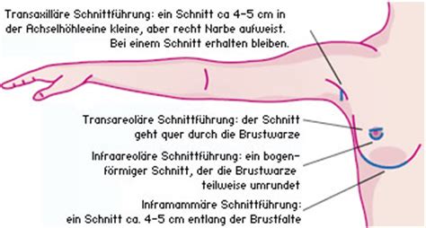 Brustvergr Erung Br Ste Vergr Ern Brustaugmentation