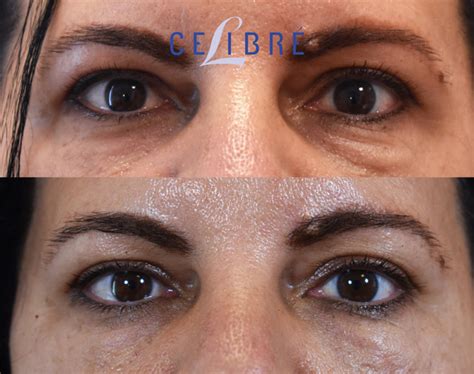 Juvederm Injections Cost