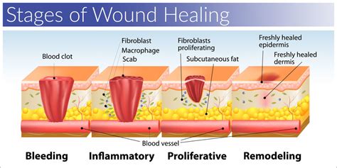 Stages And Process Of Wound Healing Medchrometube Bes